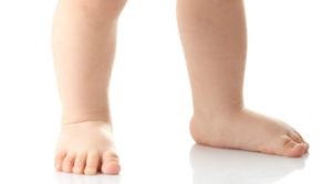 Pediatric Flatfoot - Dr. Francisco J. Olvia DPM